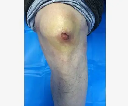 低温烫伤治疗心得_手机游戏低温烫伤_低温烫伤自愈